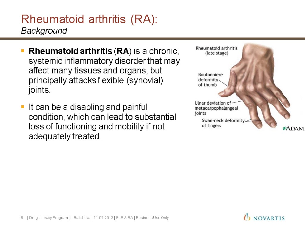 Rheumatoid arthritis (RA): Background Rheumatoid arthritis (RA) is a chronic, systemic inflammatory disorder that